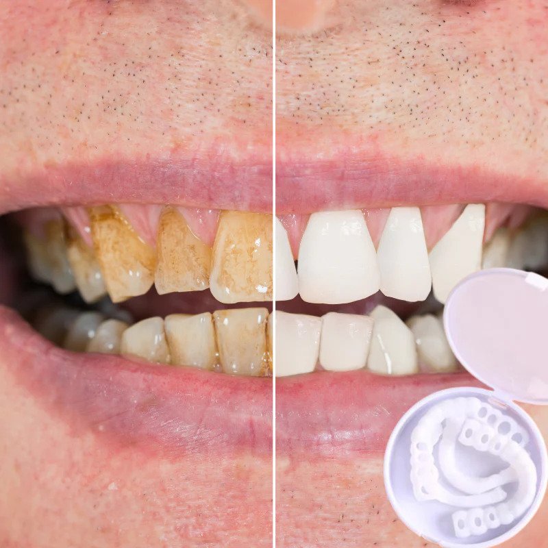 Snap-On Veneers | Flexible, Glue-Free Fit for Meals and Daily Use