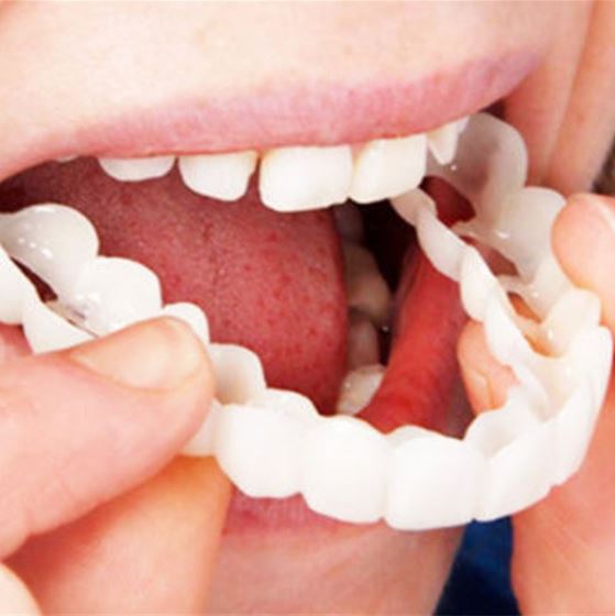 Snap-On Veneers | Flexible, Glue-Free Fit for Meals and Daily Use