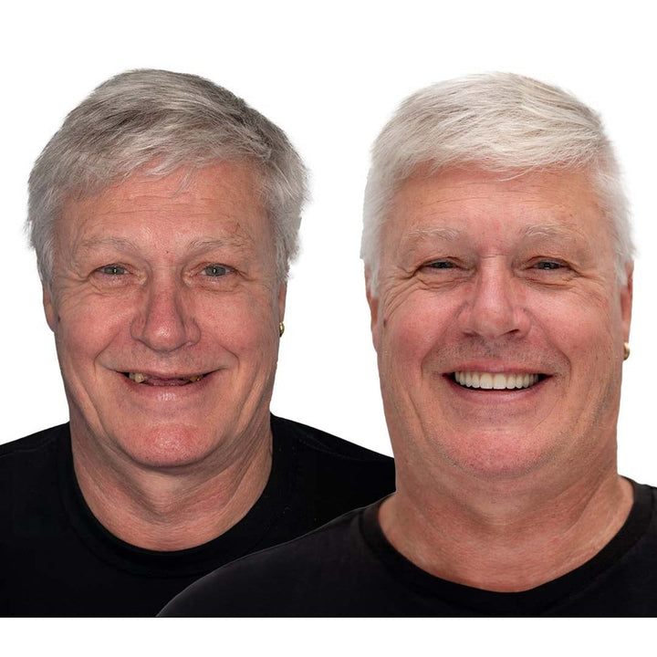 Removable full-arch denture set with flexible cushioned grip for daily use