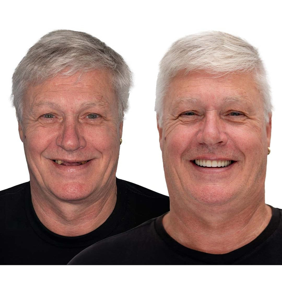 Removable Full-Arch Denture Set with Flexible Cushion Grip for Daily Use