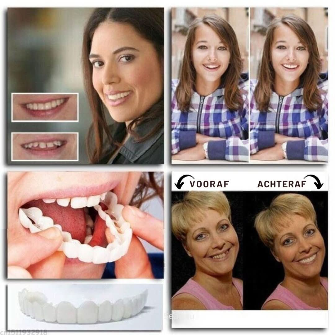 Snap-On Dental Veneers | Adjustable
